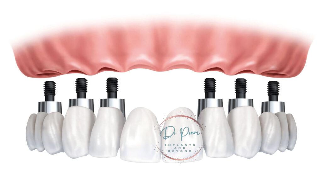 Dental Implants: Regaining Your Smile