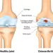 How Does Stem Cell Therapy Address Knee Osteoarthritis in India?