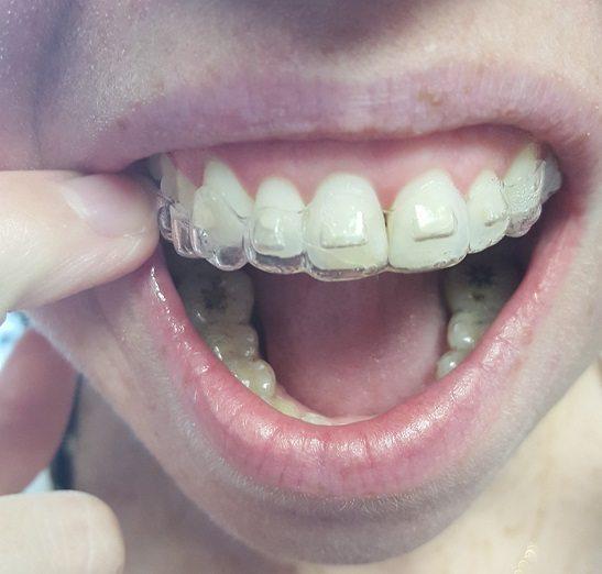 Invisalign Cost Analysis: Long-Term Benefits vs. Short-Term Expenses at Amma Naana Dental Clinic