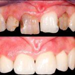 Enhancing Smiles In London With Dental Crowns