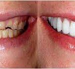 Veneers Treatment in Manchester: Achieving a Radiant Smile