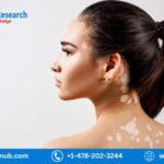 Global Vitiligo Treatment Market, Size, Share, Growth | Forecast 2023-2028 | Renub Research