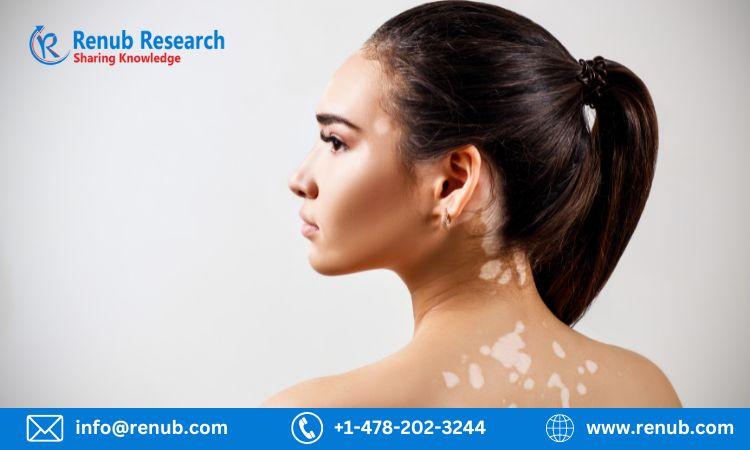 Global Vitiligo Treatment Market, Size, Share, Growth | Forecast 2023-2028 | Renub Research