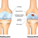 How Does Stem Cell Therapy Address Knee Osteoarthritis in India?