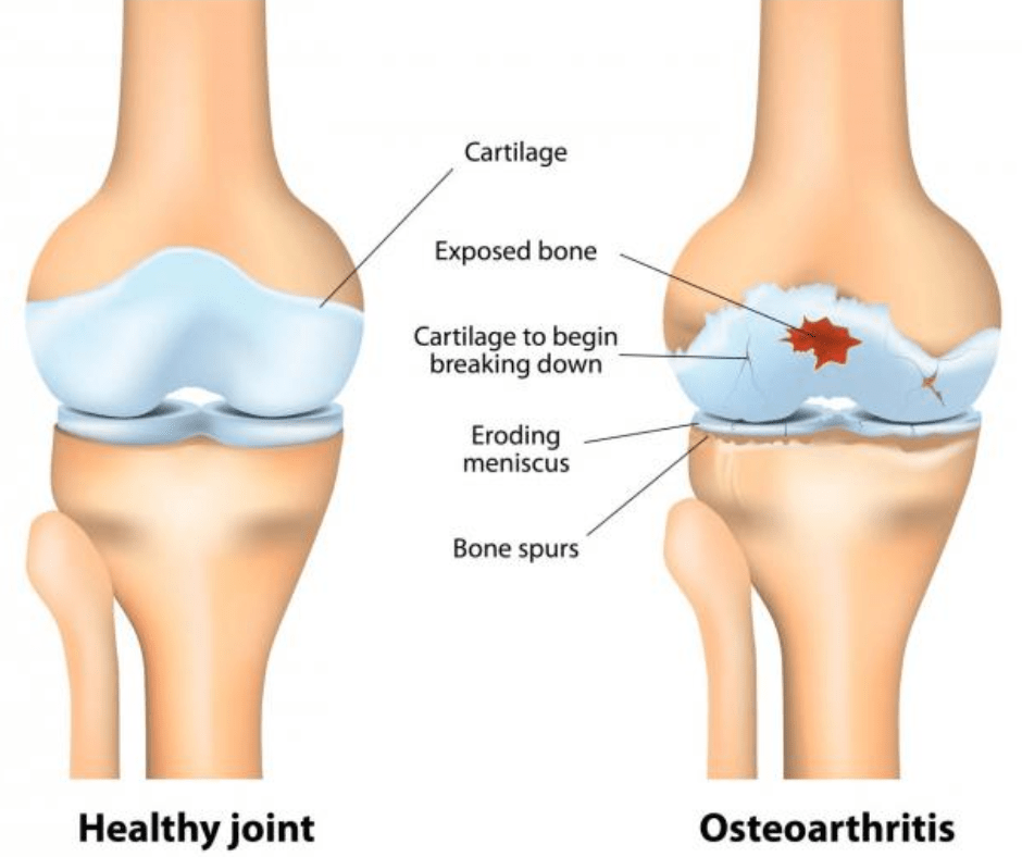 How Does Stem Cell Therapy Address Knee Osteoarthritis in India?