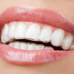 Invisible Teeth Aligners in Barrow: A Clear Path to a Confident Smile