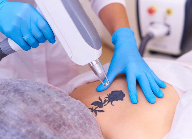 Frequently Asked Questions About Laser Tattoo Removal