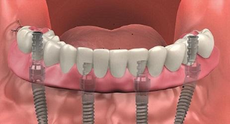 Explaining The Causes And Solutions Of Misaligned Teeth