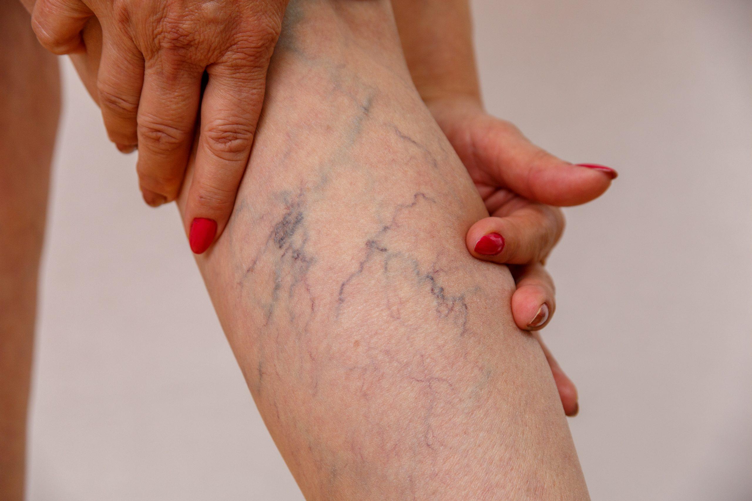 Are You Ready for Vein Treatment? Ask Yourself These Key Questions First