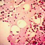 AL Amyloidosis Market Share, Epidemiology, Analysis & Trends 2023-2033