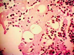 AL Amyloidosis Market Share, Epidemiology, Analysis & Trends 2023-2033