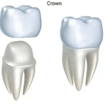 Understanding Wisdom Tooth Removal: Costs and Considerations at Lynnwood Dental Studio