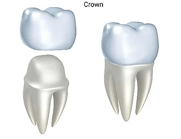 Understanding Wisdom Tooth Removal: Costs and Considerations at Lynnwood Dental Studio