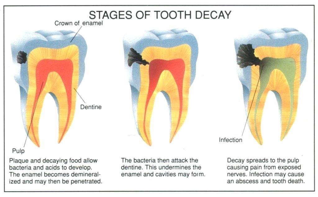 Myths and Facts About Teeth Whitening