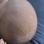 Gentle Techniques for Removing Cradle Cap Scales from Your Baby’s Scalp