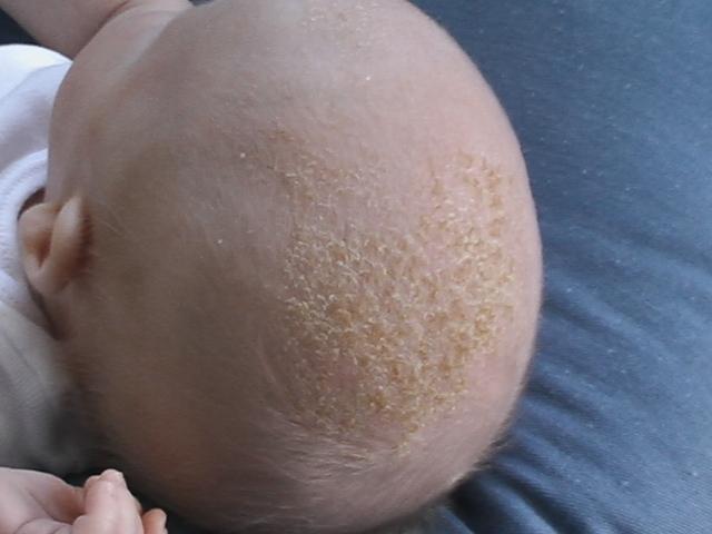 Gentle Techniques for Removing Cradle Cap Scales from Your Baby’s Scalp