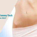 Can I Get A Tummy Tuck For Loose Skin?