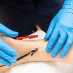 What to Expect from Your First Electroacupuncture Experience in NY