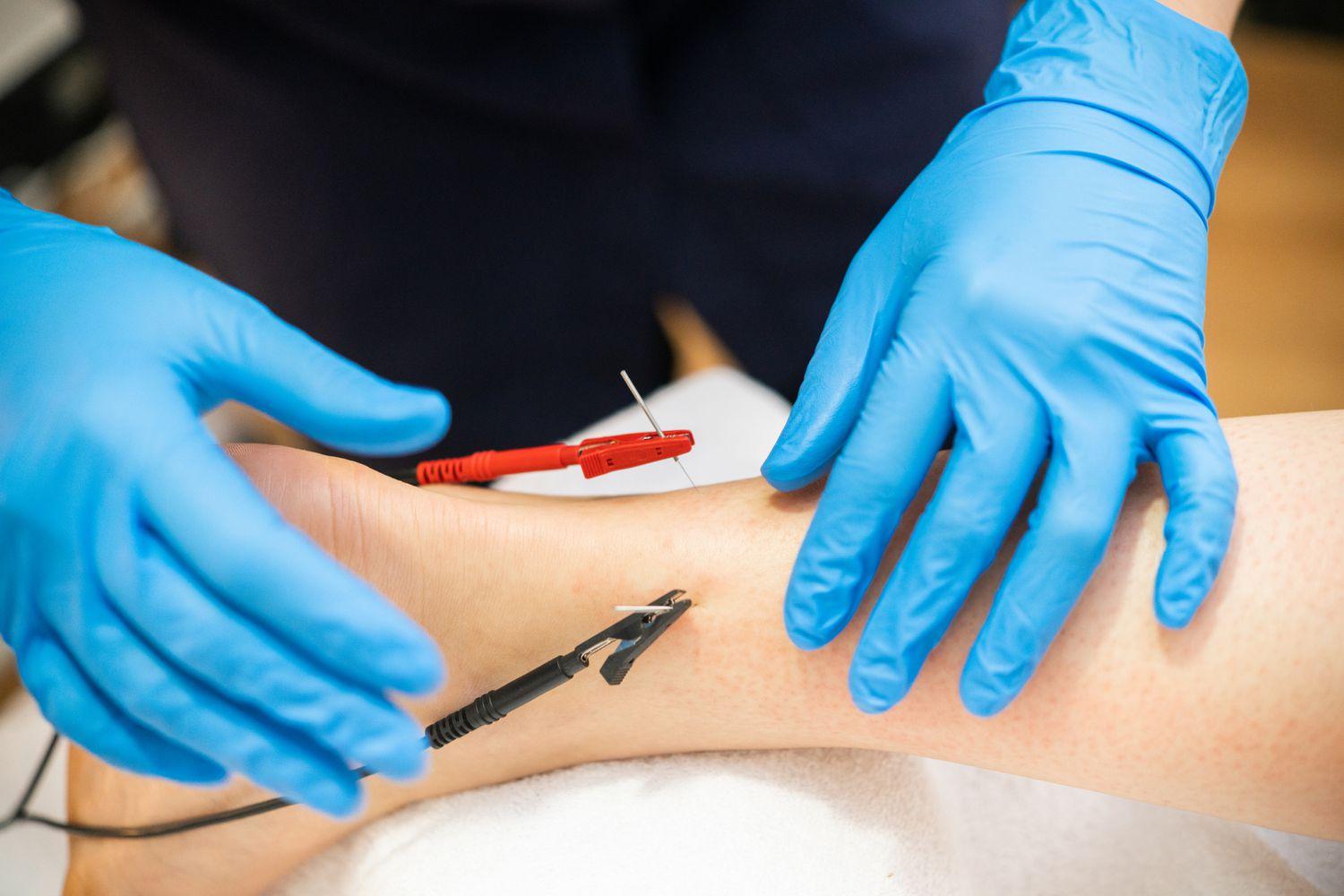 What to Expect from Your First Electroacupuncture Experience in NY