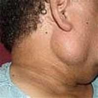 Benefits of Having Parotid Removal Surgery