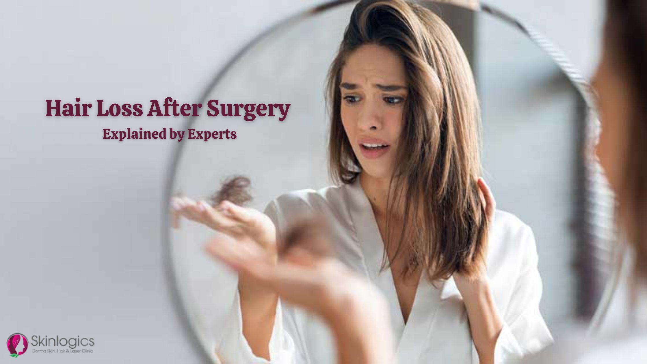 Hair Loss After Surgery Explained by Experts