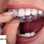 The Power of Invisalign and Dental Implants in achieving a superb Smile