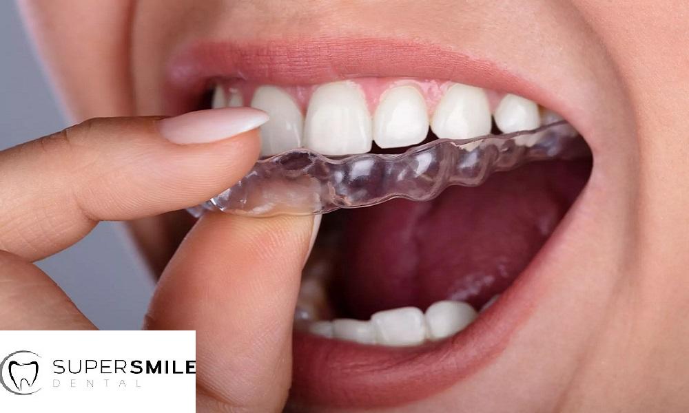 The Power of Invisalign and Dental Implants in achieving a superb Smile