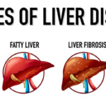 Fatty Liver Disease and Nutrition: A Comprehensive Study