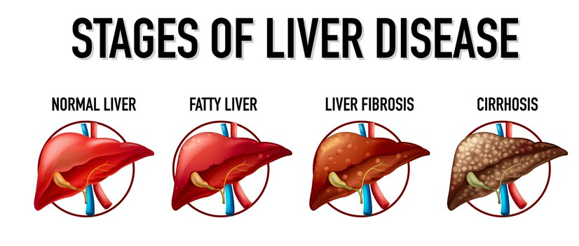 Fatty Liver Disease and Nutrition: A Comprehensive Study