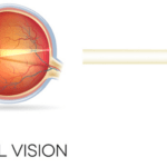 Global Astigmatism Market Size, Share, Trend and Forecast 2022-2032