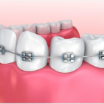 What are the Best Braces to Straighten Teeth?