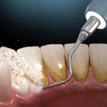 What Are The Key Methods For Effective Gum Treatment?