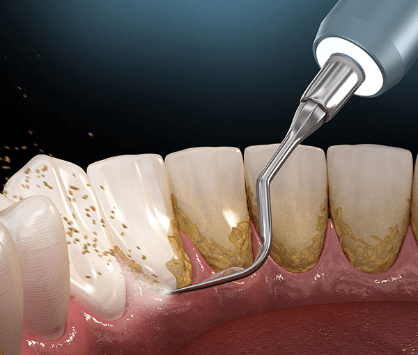 What Are The Key Methods For Effective Gum Treatment?