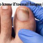 Find out how to know if toenail fungus is dying…