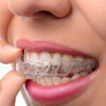 Dental Bonding And Dental Veneers Are Not The Same Thing