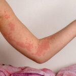 What is the most effective treatment for a skin infection?