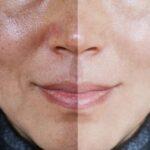 Illuminating Beauty: Discovering the Best Skin Lightening Products for Gentle Melasma Treatment