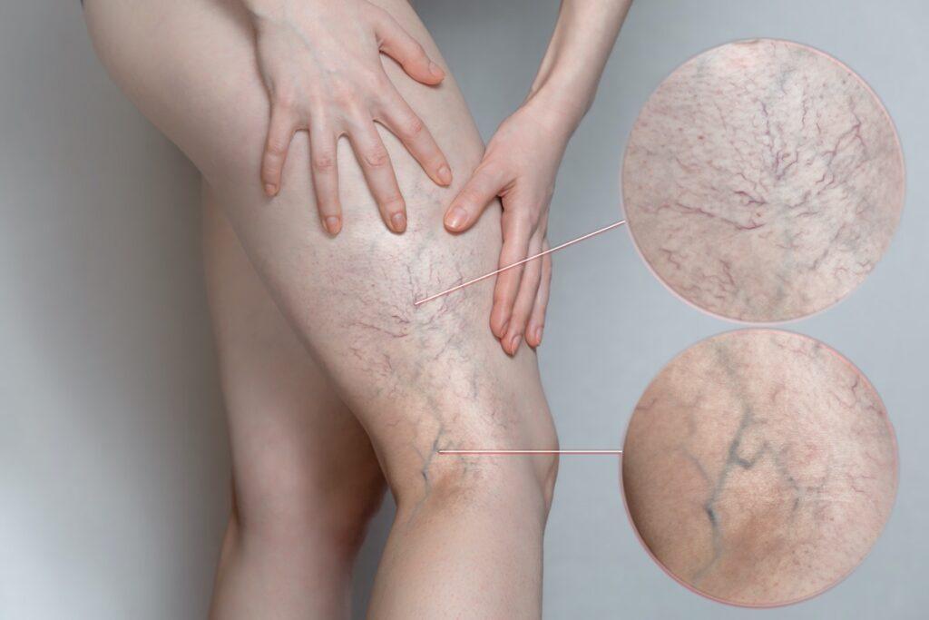 Unmasking the Secrets of Spider Veins: What Your Vascular Lesions Are Trying to Tell You