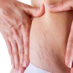 The Truth About Laser Stretch Mark Removal