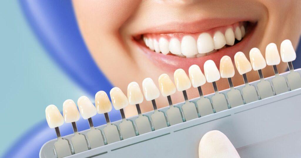 Teeth Whitening: Discover Effective Methods And Achieve A Brighter Smile