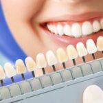 Teeth Whitening: Discover Effective Methods And Achieve A Brighter Smile