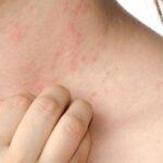 Hives Or Urticaria In Children & Teenagers