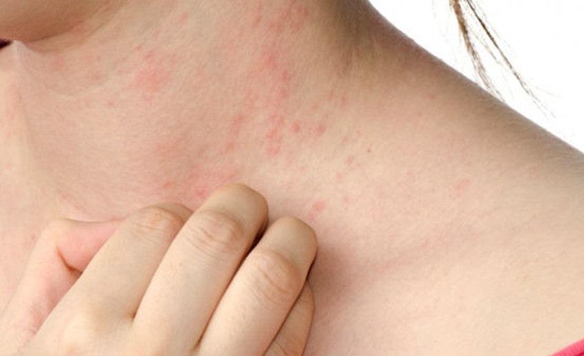 Hives Or Urticaria In Children & Teenagers