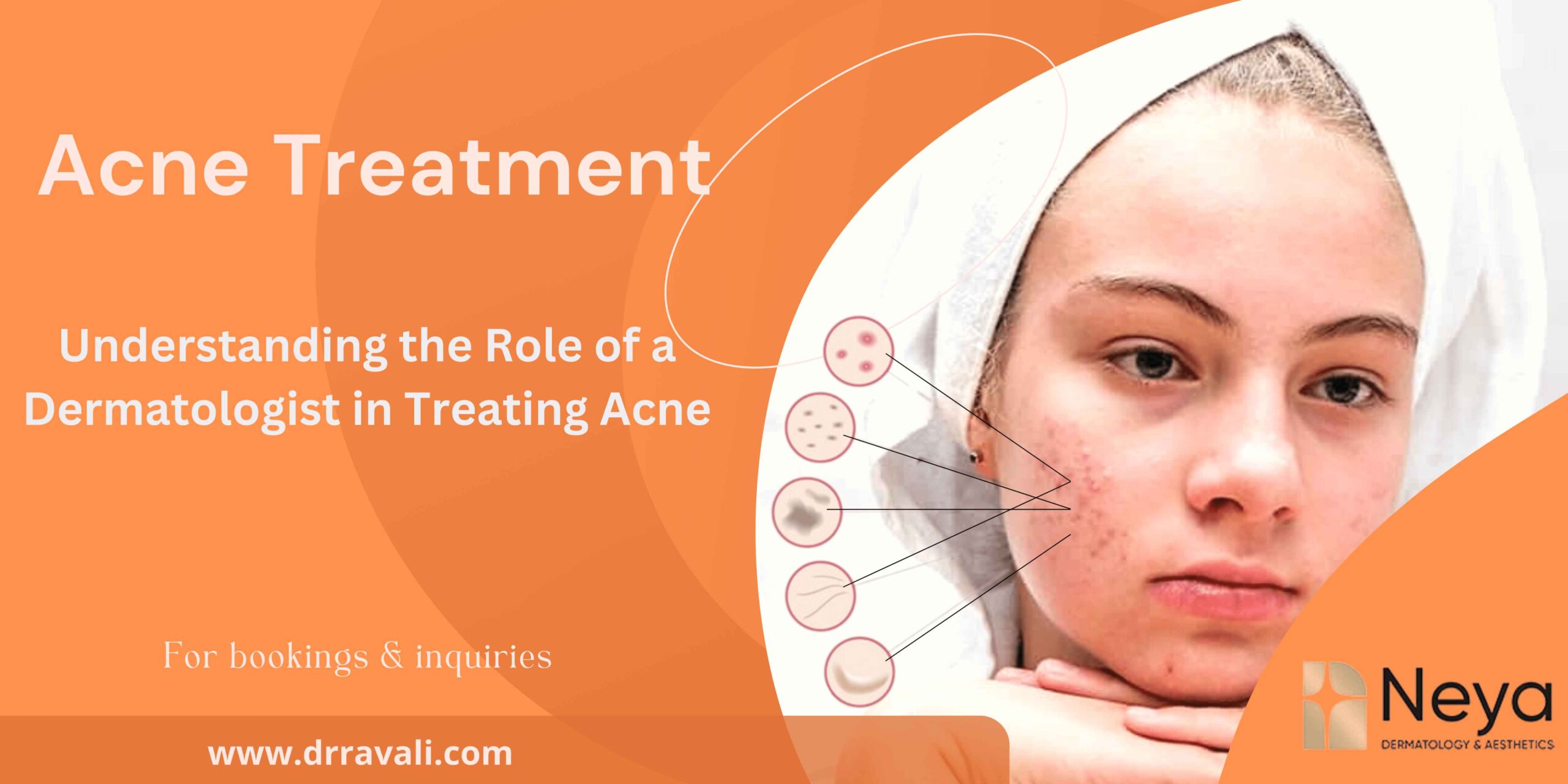 Understanding the Role of a Dermatologist in Treating Acne in Hyderabad