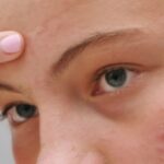 Why Do I Get Frequent Pimples On My Eyebrows?